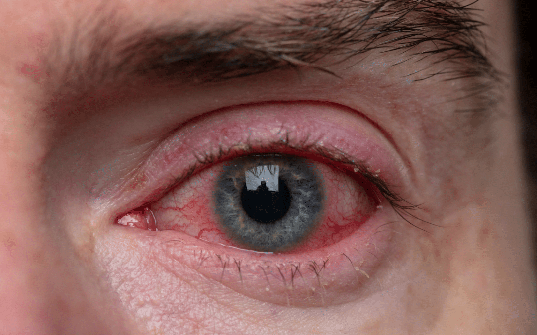Vision Warnings: Top 10 Eye Infections and Their Tell-Tale Symptoms
