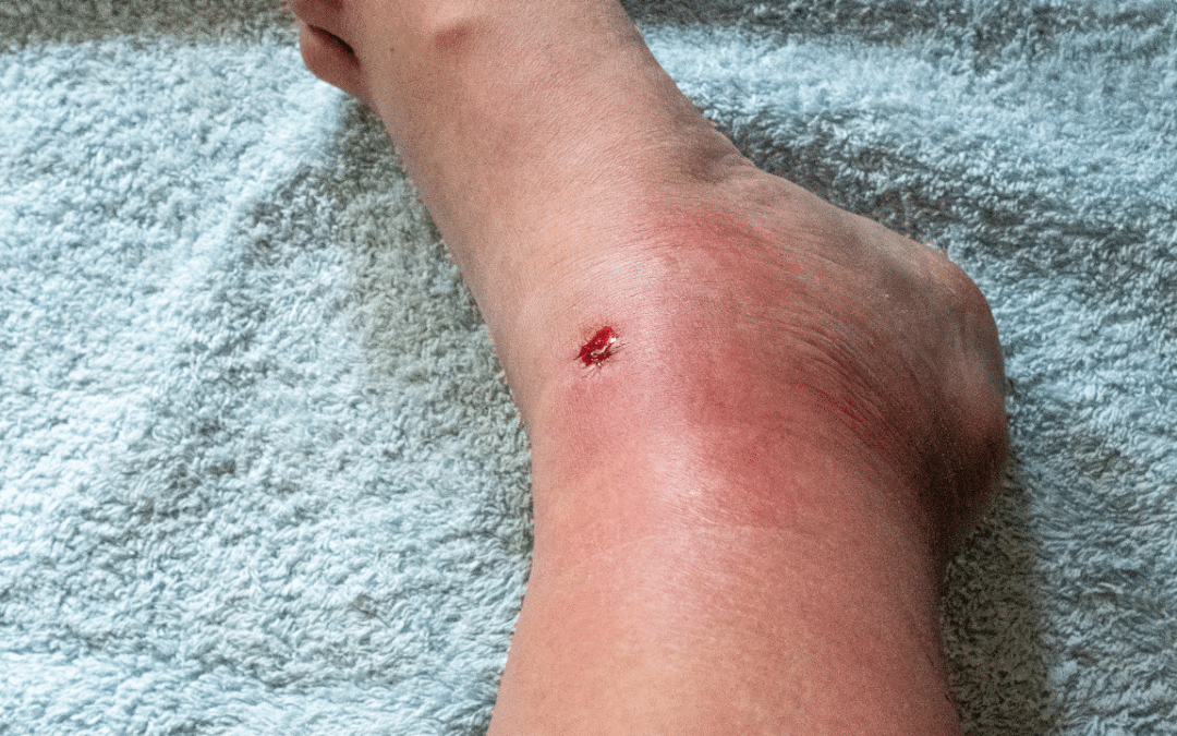 Can a Puncture Wound Cause Systemic Infection? Recognizing the Red Flags