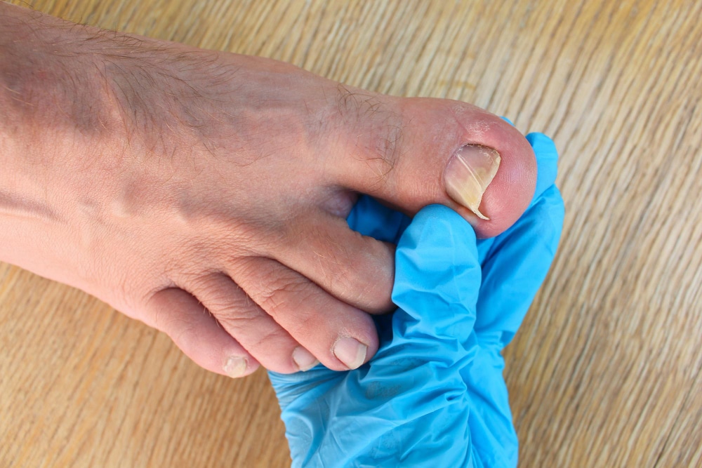 Signs of Infection after Stepping on a Nail