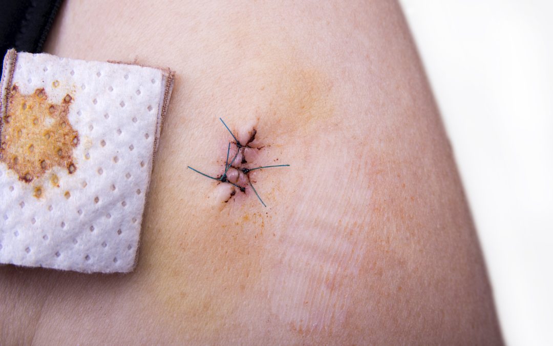 What are non dissolvable stitches made of in Chicago?