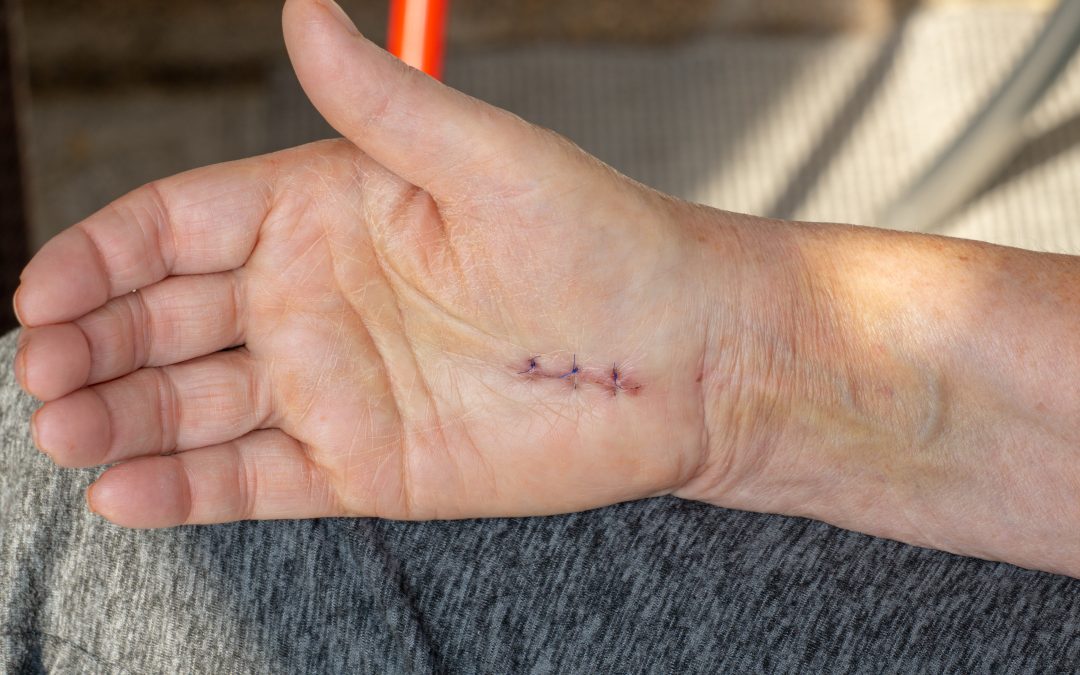 When are stitches ready to come out in Chicago?