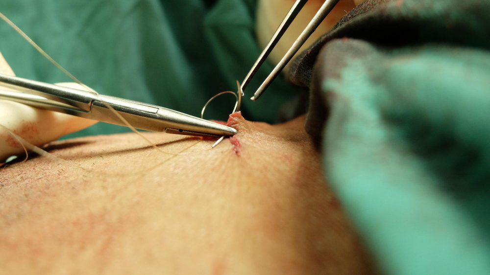 When Are Stitches Ready To Come Out In Chicago? 1 Timing Matters for Stitch Removal