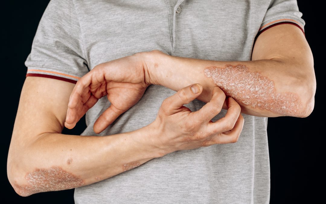 Does Alcohol Kill Ringworm on Surfaces in Chicago?