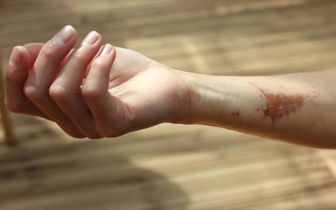 How to get prickles out of skin in Chicago?