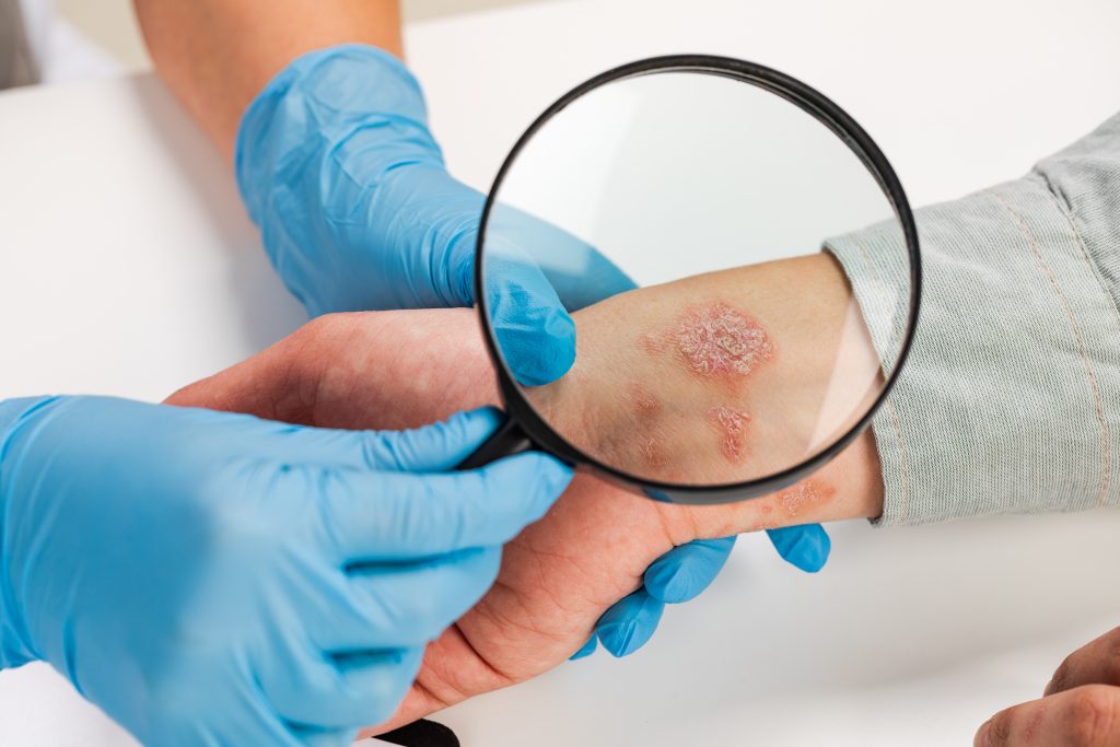 Does Alcohol Kill Ringworm On Surfaces In Chicago? dermatologist wearing gloves examines skin sick patient examination diagnosis skin diseases allergies psoriasis eczema dermatitis