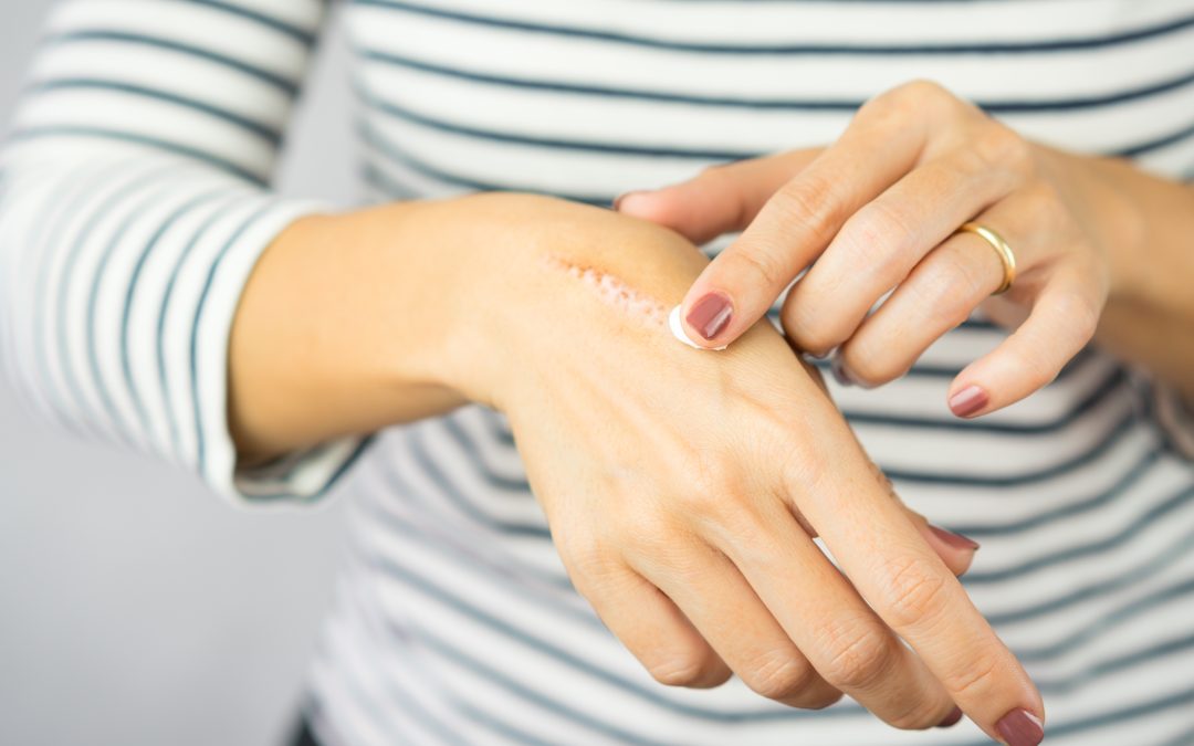 Why put vaseline on stitches in Naperville?